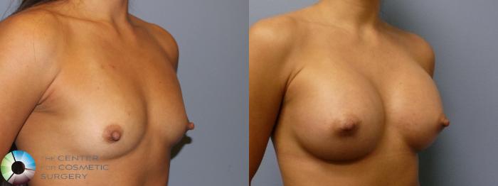 Before & After Breast Augmentation Case 11324 Right Oblique View in Golden, CO