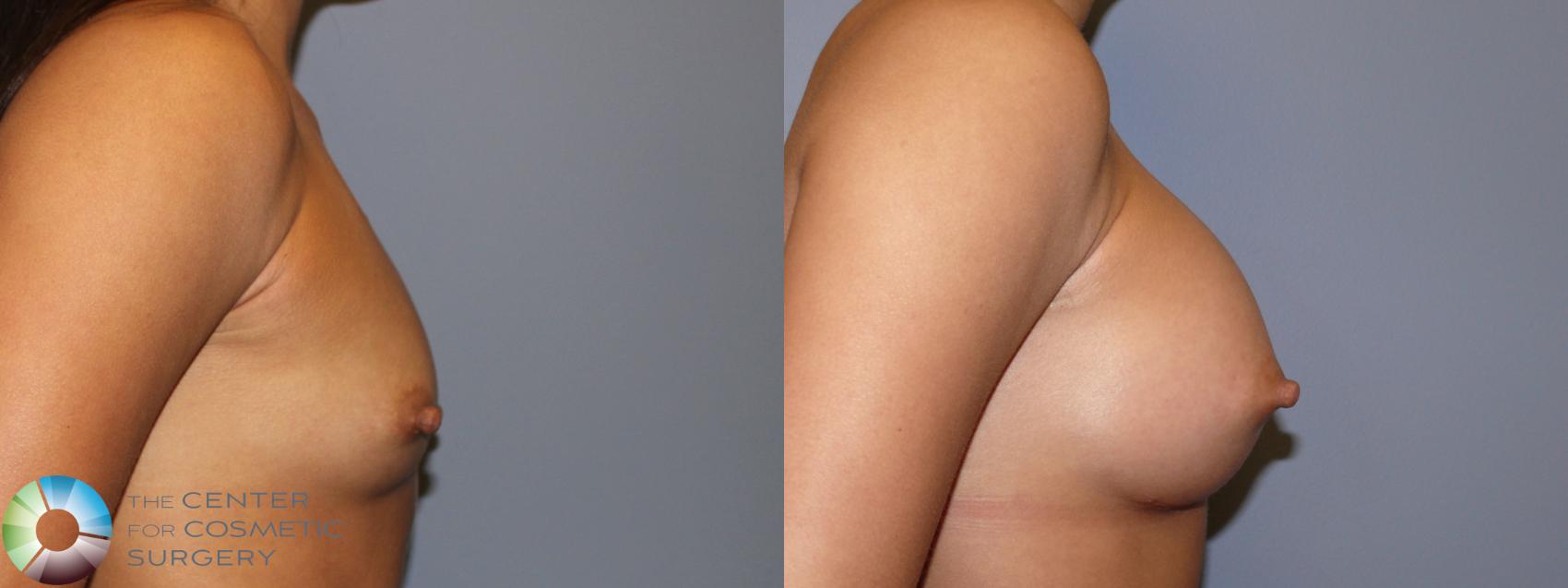 Before & After Breast Augmentation Case 11324 Right Side in Denver and Colorado Springs, CO