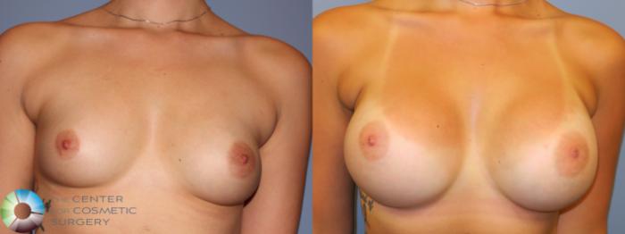 Before & After Breast Augmentation Case 11325 Front in Denver and Colorado Springs, CO