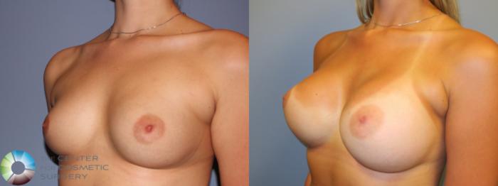 Before & After Breast Augmentation Case 11325 Left Oblique in Denver and Colorado Springs, CO