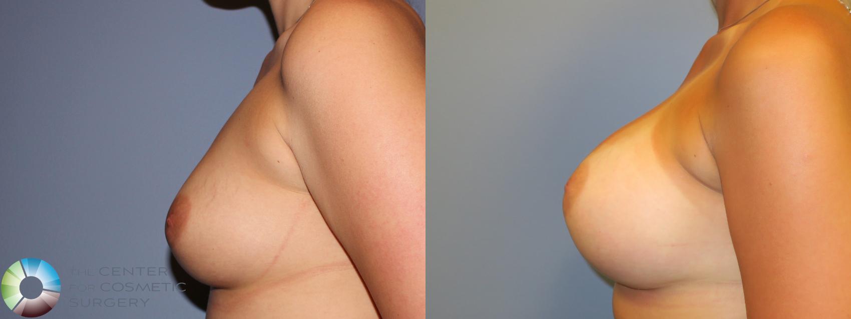 Before & After Breast Augmentation Case 11325 Left Side in Denver and Colorado Springs, CO