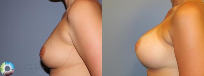 Before & After Breast Augmentation Case 11325 Left Side in Denver and Colorado Springs, CO