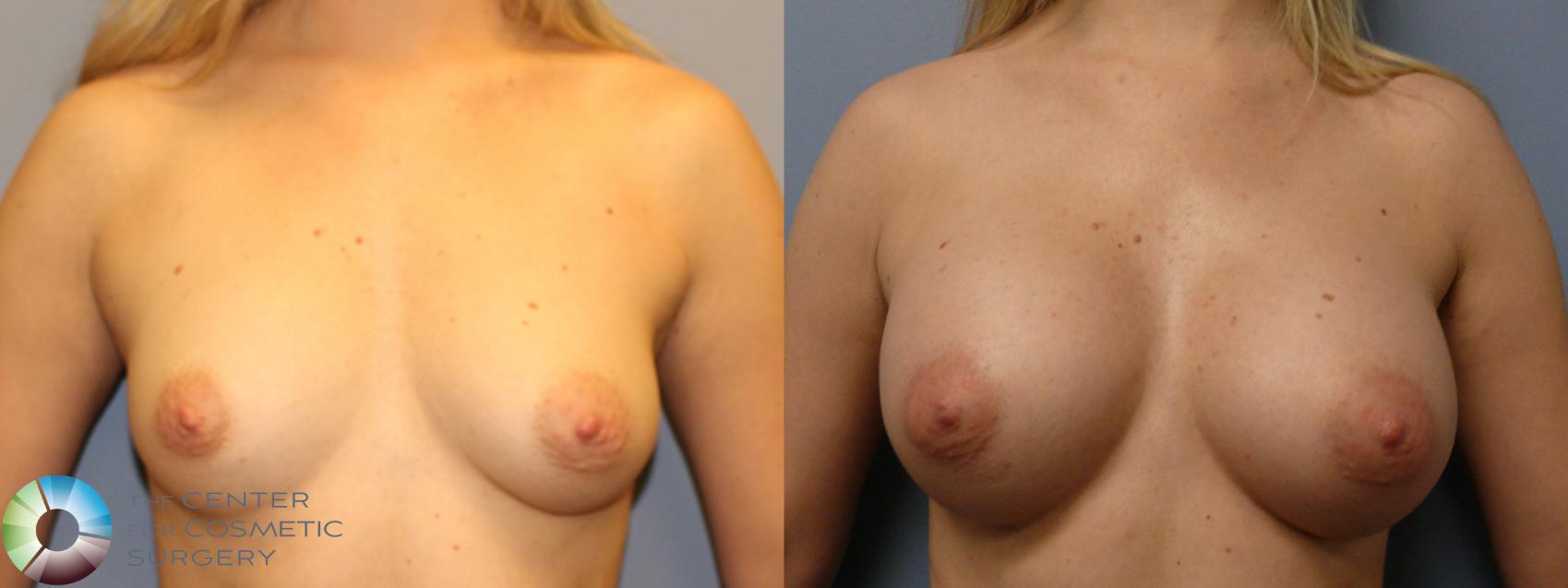 Before & After Breast Augmentation Case 11327 Front in Denver and Colorado Springs, CO