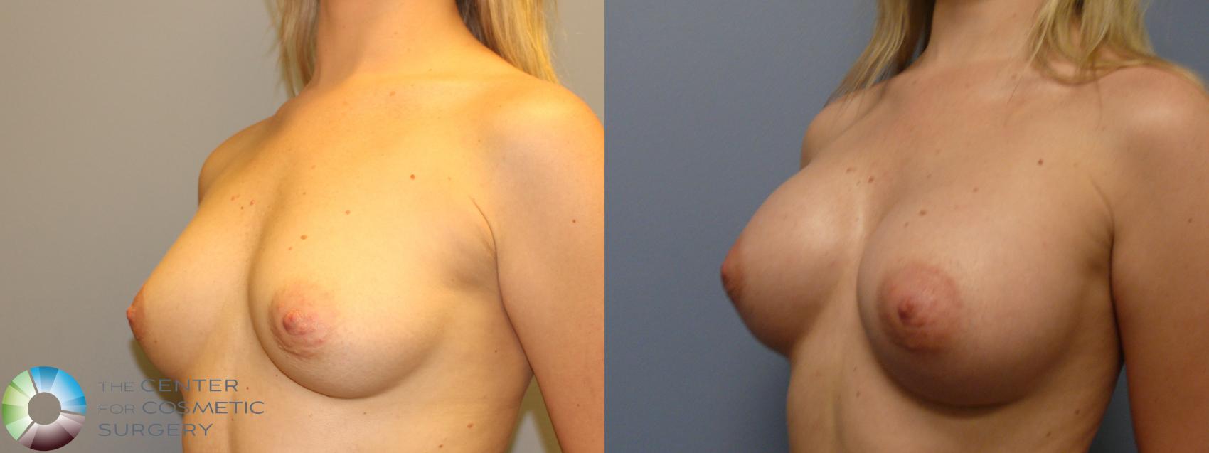 Best Denver Breast Implants/Augmentation