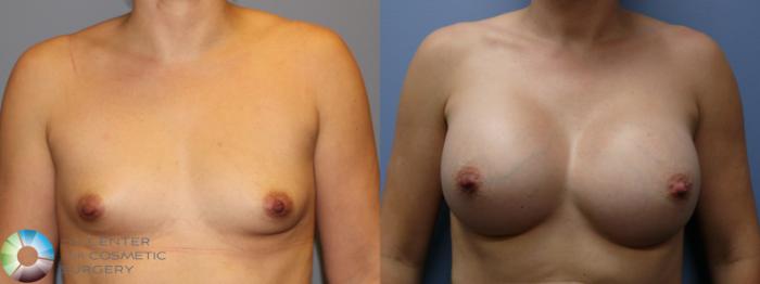 Before & After Breast Augmentation Case 11328 Front View in Golden, CO