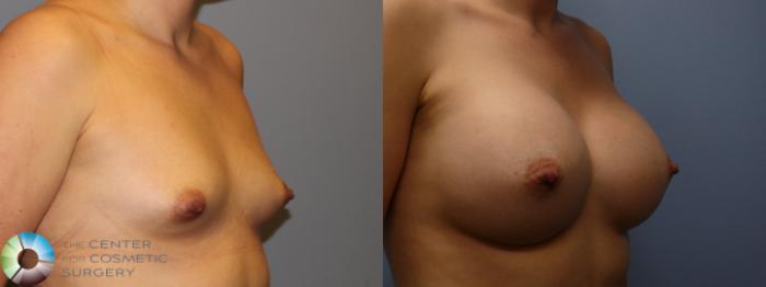 Before & After Breast Augmentation Case 11328 Right Oblique View in Golden, CO