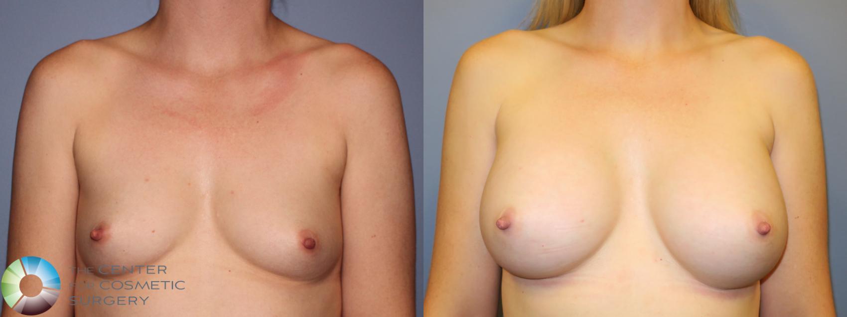 Before & After Breast Augmentation Case 11330 Front View in Golden, CO