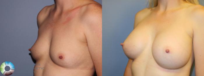 Before & After Breast Augmentation Case 11330 Left Oblique View in Golden, CO