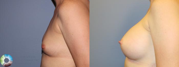 Before & After Breast Augmentation Case 11330 Left Side View in Golden, CO