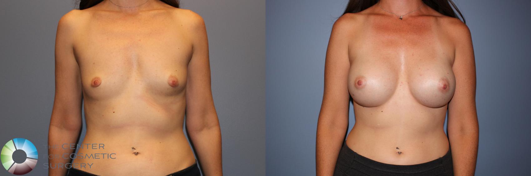 Before & After Breast Augmentation Case 11331 Front in Denver and Colorado Springs, CO