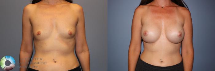 Before & After Breast Augmentation Case 11331 Front View in Golden, CO