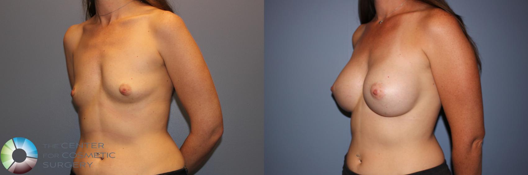 Before & After Breast Augmentation Case 11331 Left Oblique in Denver and Colorado Springs, CO