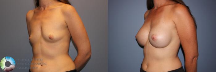 Before & After Breast Augmentation Case 11331 Left Oblique View in Golden, CO