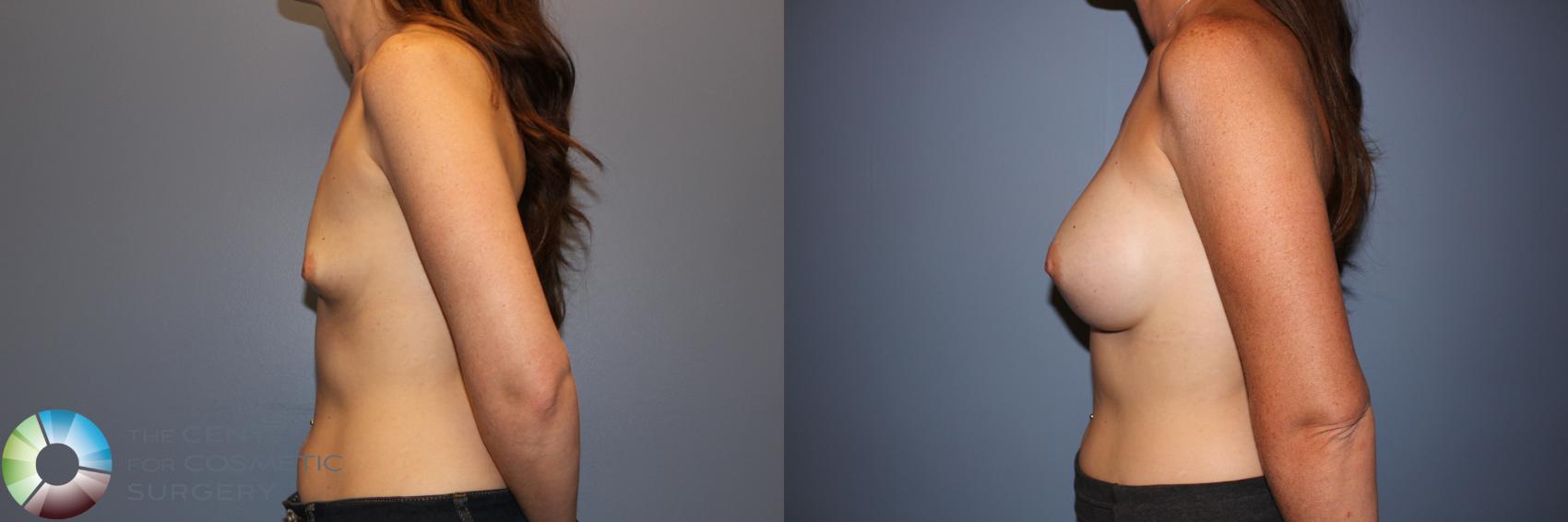 Before & After Breast Augmentation Case 11331 Left Side in Denver and Colorado Springs, CO