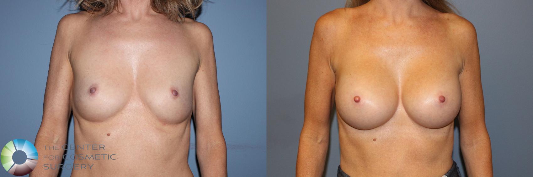 Before & After Breast Augmentation Case 11333 Front View in Golden, CO
