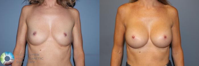 Before & After Breast Augmentation Case 11333 Front View in Golden, CO