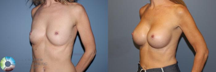 Before & After Breast Augmentation Case 11333 Left Oblique View in Golden, CO