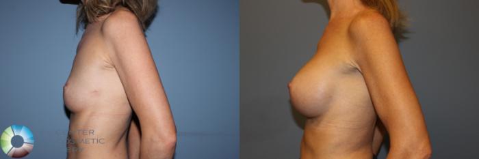 Before & After Breast Augmentation Case 11333 Left Side View in Golden, CO