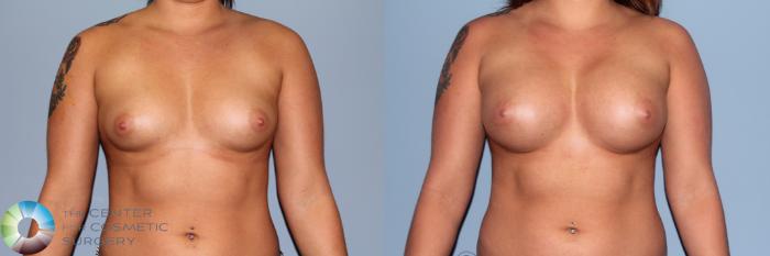 Before & After Breast Augmentation Case 11335 Front in Denver and Colorado Springs, CO