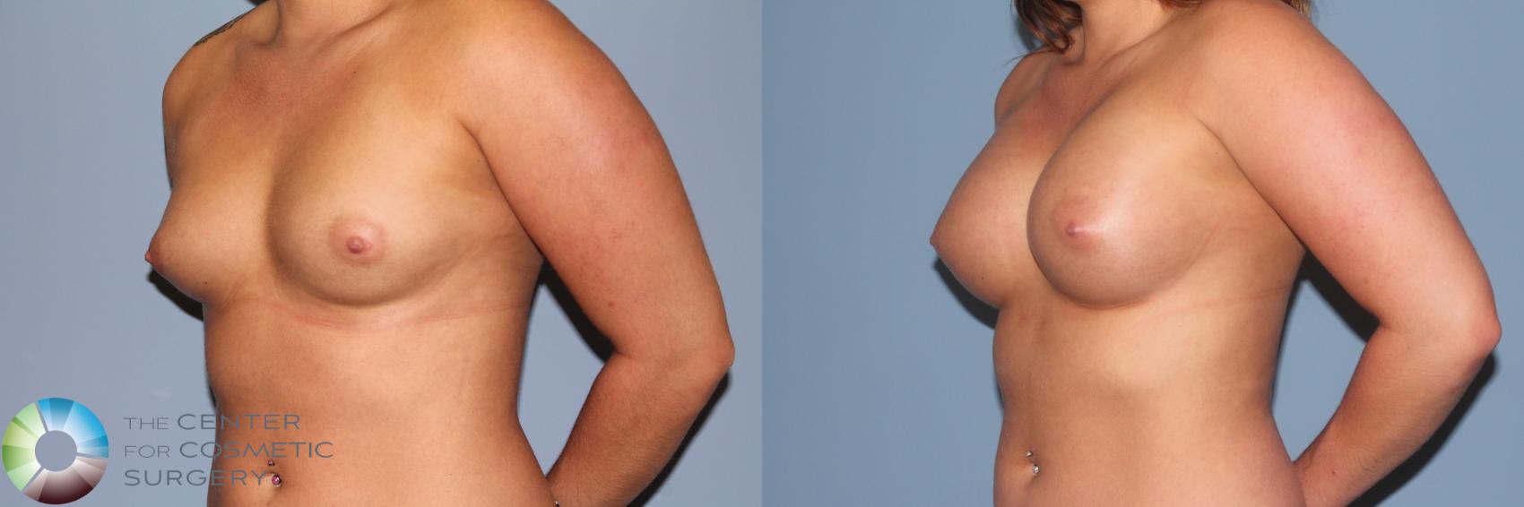 Before & After Breast Augmentation Case 11335 Left Oblique View in Golden, CO
