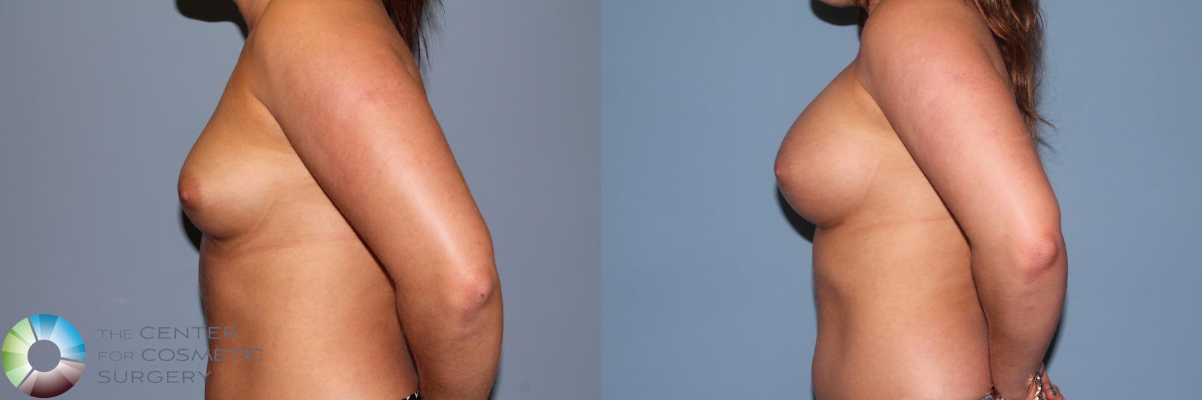 Before & After Breast Augmentation Case 11335 Left Side View in Golden, CO