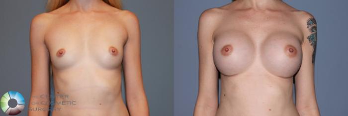 Before & After Breast Augmentation Case 11336 Front in Denver and Colorado Springs, CO