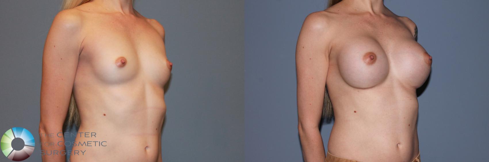 Before & After Breast Augmentation Case 11336 Right Oblique View in Golden, CO