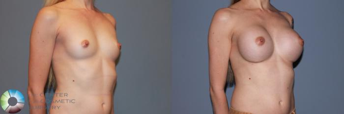 Before & After Breast Augmentation Case 11336 Right Oblique in Denver and Colorado Springs, CO