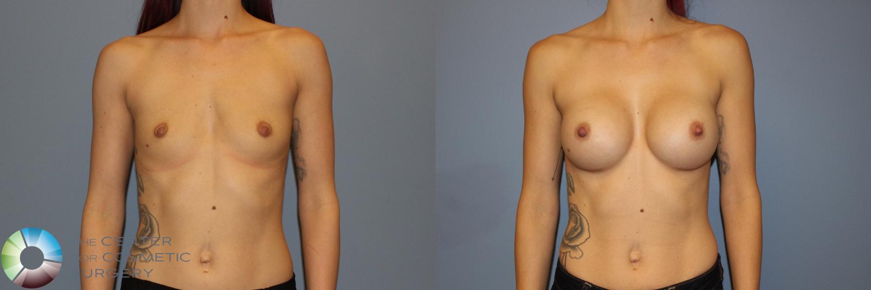 Before & After Breast Augmentation Case 11337 Front in Denver and Colorado Springs, CO