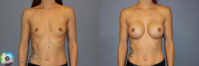 Before & After Breast Augmentation Case 11337 Front View in Golden, CO