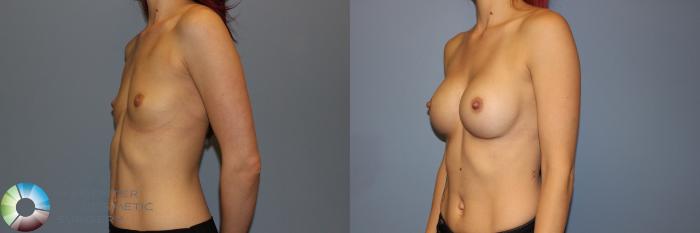 Before & After Breast Augmentation Case 11337 Left Oblique View in Golden, CO