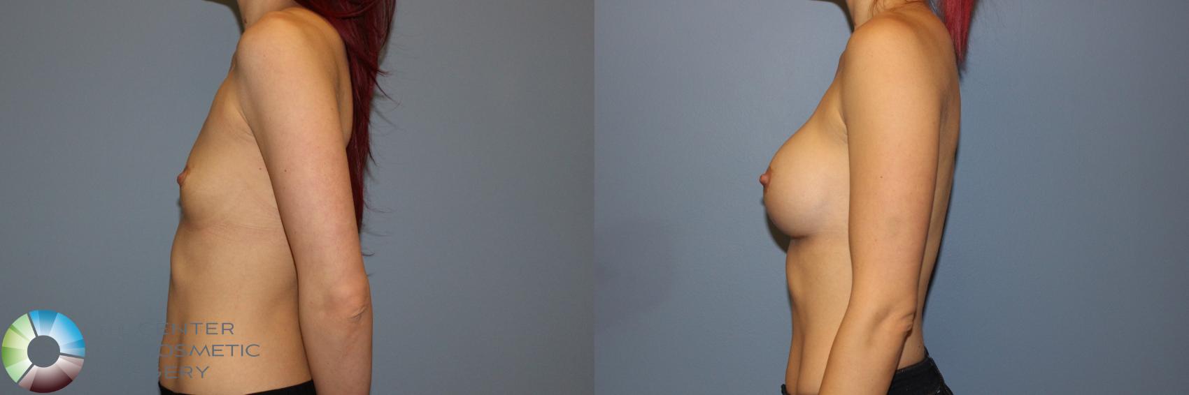 Before & After Breast Augmentation Case 11337 Left Side View in Golden, CO
