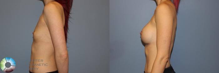 Before & After Breast Augmentation Case 11337 Left Side View in Golden, CO