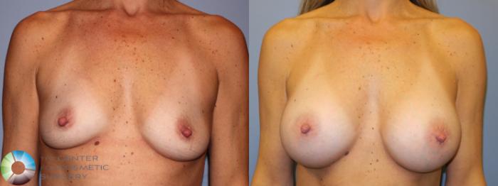 Before & After Breast Augmentation Case 11340 Front in Denver and Colorado Springs, CO