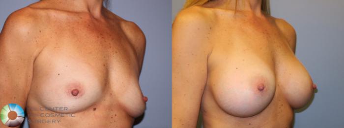 Before & After Breast Augmentation Case 11340 Right Oblique in Denver and Colorado Springs, CO