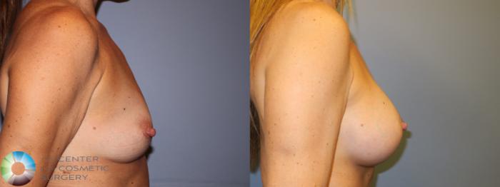 Before & After Breast Augmentation Case 11340 Right Side in Denver and Colorado Springs, CO