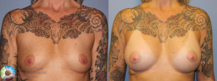 Before & After Breast Augmentation Case 11342 Front in Denver and Colorado Springs, CO