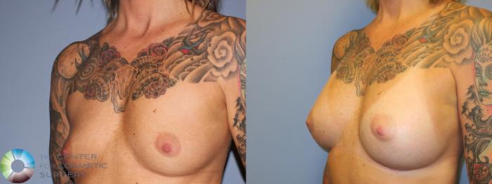Before & After Breast Augmentation Case 11342 Left Oblique in Denver and Colorado Springs, CO