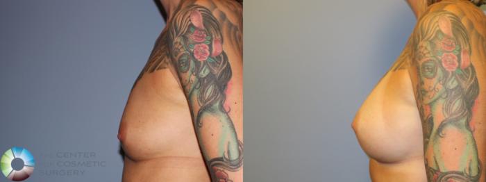 Before & After Breast Augmentation Case 11342 Left Side in Denver and Colorado Springs, CO