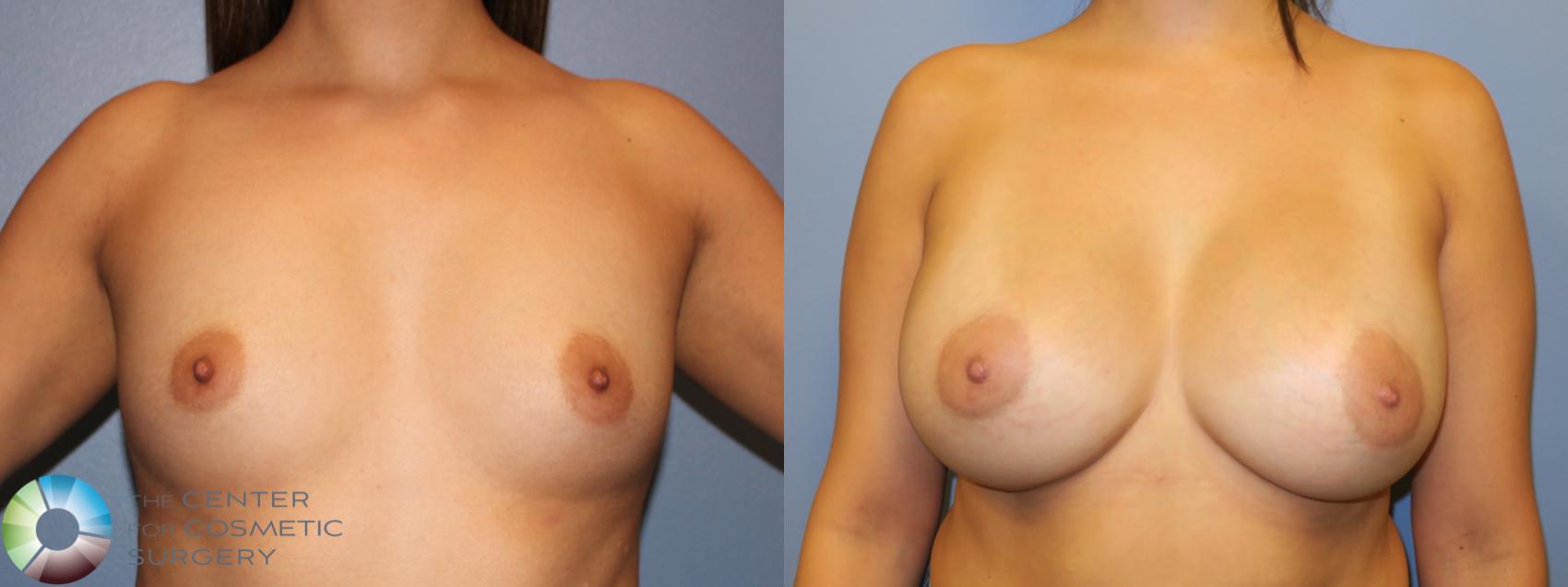 Before & After Breast Augmentation Case 11350 Front in Denver and Colorado Springs, CO