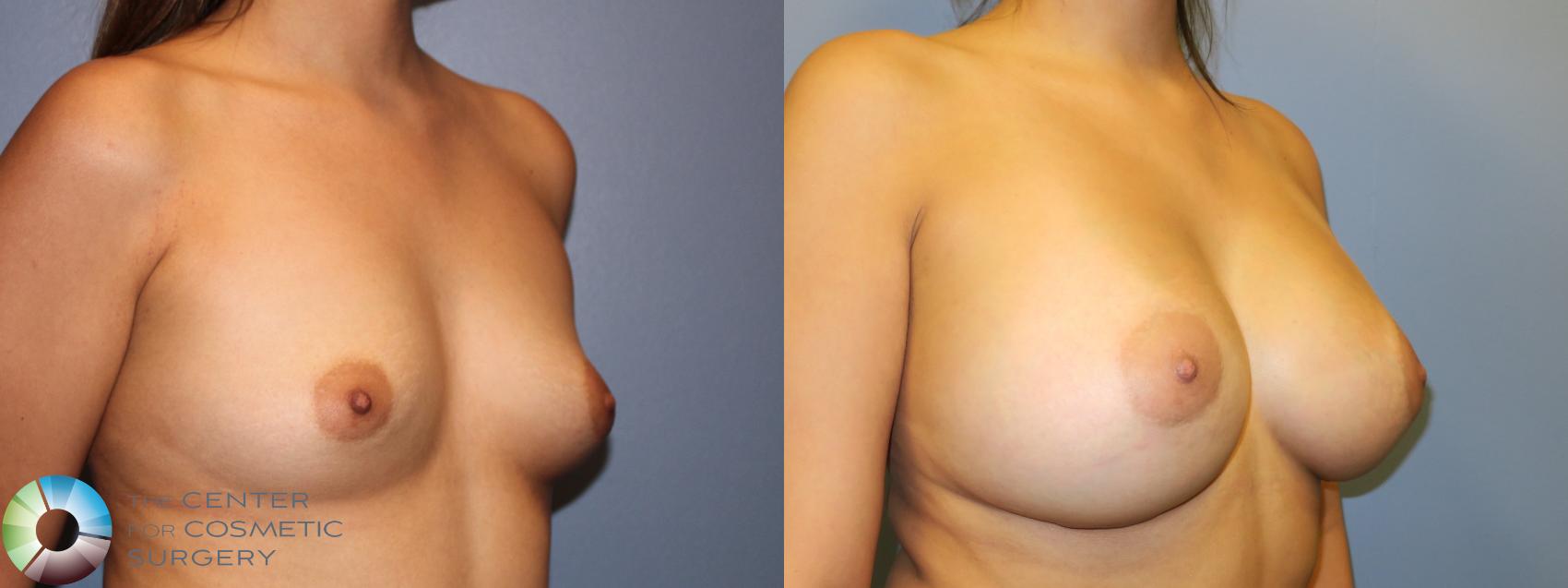 Best Denver Colorado Breast Implants Augmentation