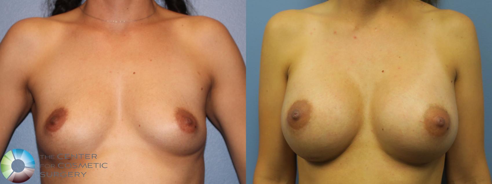 Before & After Breast Augmentation Case 11351 Front View in Golden, CO