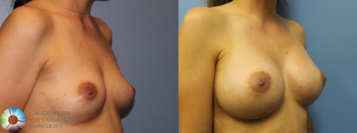 Before & After Breast Augmentation Case 11351 Right Oblique View in Golden, CO