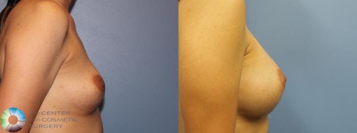 Before & After Breast Augmentation Case 11351 Right Side View in Golden, CO