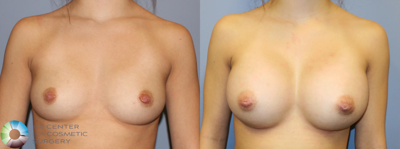 Before & After Breast Augmentation Case 11352 Front in Denver, CO