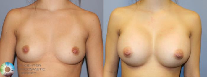 Before & After Inverted Nipple Repair Case 11352 Front View in Golden, CO