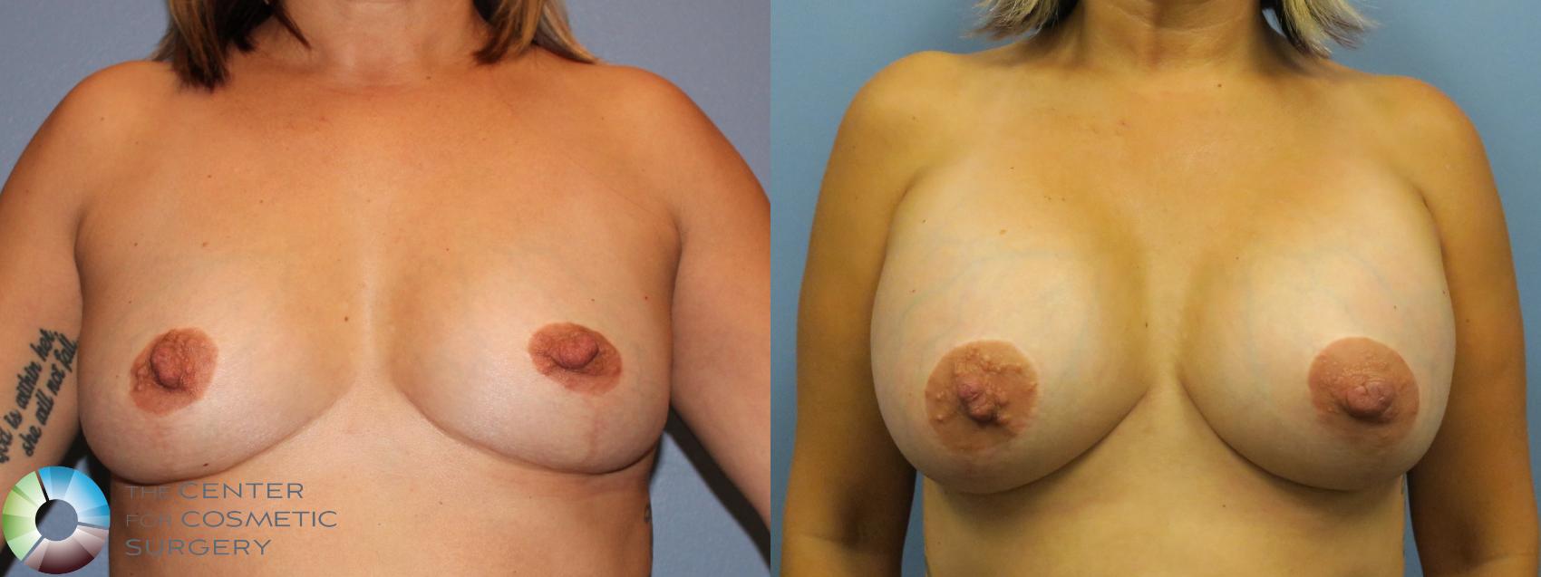 Before & After Breast Augmentation Case 11353 Front in Denver and Colorado Springs, CO