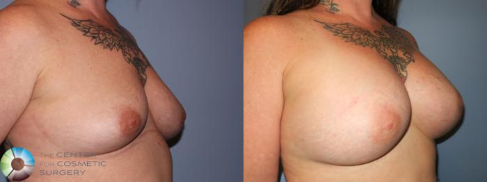 Before & After Breast Augmentation Case 11355 Right Oblique in Denver and Colorado Springs, CO