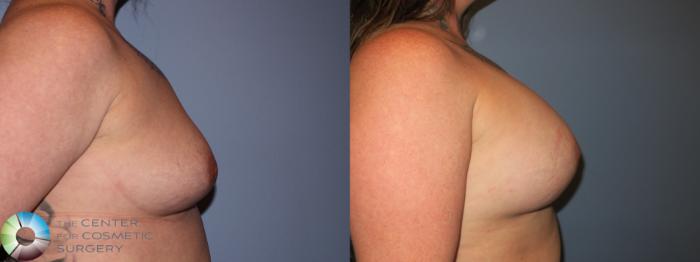 Before & After Breast Augmentation Case 11355 Right Side in Denver and Colorado Springs, CO