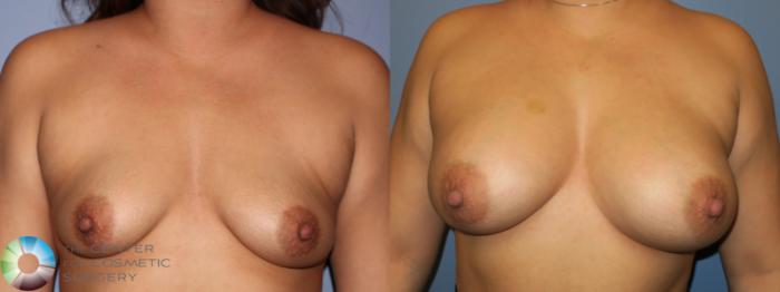 Before & After Breast Augmentation Case 11356 Front View in Golden, CO
